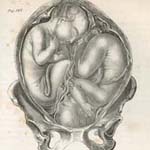 Pl. LII. “Twins in utero: the head of one presenting, the breech of the other; Secondary foetus three months of age.” Plate printed by Thomas Sinclair in Francis H. Ramsbotham, The Principles and Practice of Obstetric Medicine and Surgery, in Reference to the Process of Parturition. Illustrated by One Hundred and Forty-Eight Plates (Philadelphia: Lea & Blanchard, 1849). 